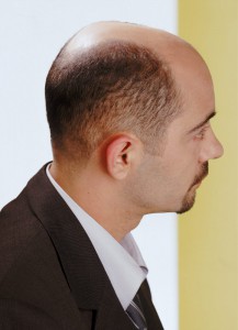 chute_de_cheveux